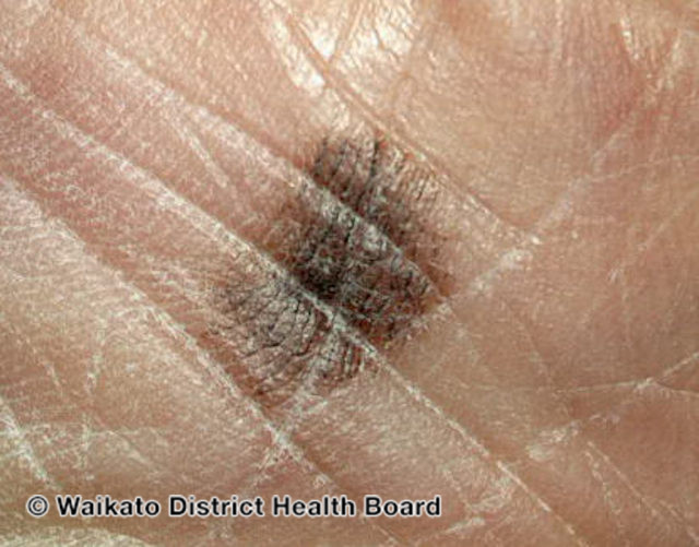 File:Acral lentiginous melanoma (DermNet NZ Acral-lentiginous-melanoma-3).jpg