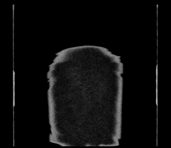 Acromioclavicular joint cyst (Radiopaedia 58455-65610 Coronal C+ arterial phase 148).jpg
