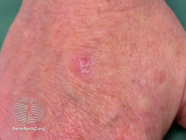 File:Actinic keratoses affecting the hands (DermNet NZ lesions-ak-hands-544).jpg