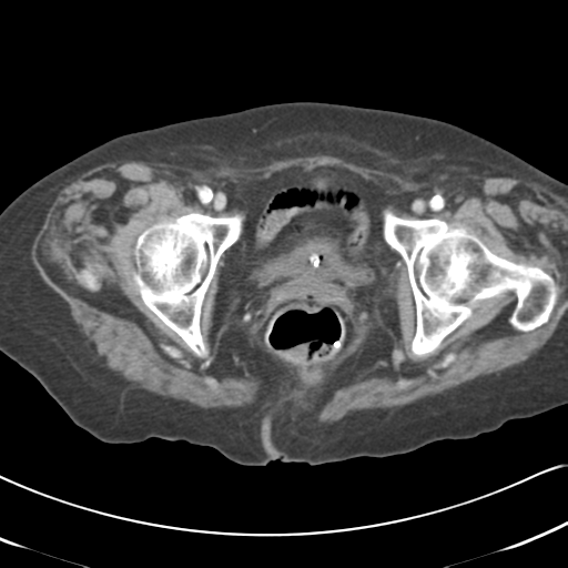 Active bleeding from duodenal ulcer with embolization (Radiopaedia 34216-35481 C 64).png