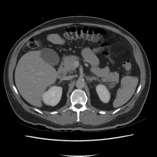 File:Active colonic bleed on CT (Radiopaedia 49765-55025 Axial C+ delayed 27).jpg