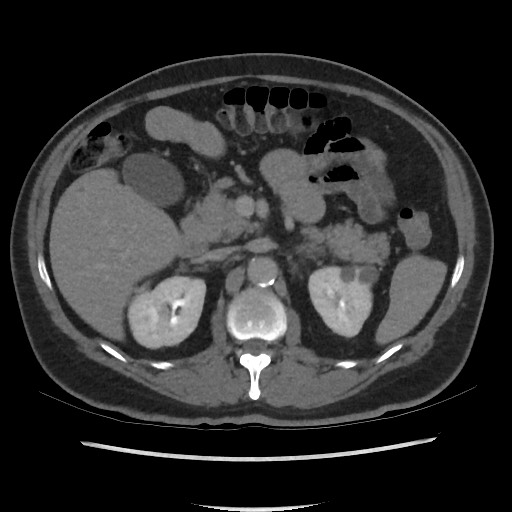 File:Active colonic bleed on CT (Radiopaedia 49765-55025 Axial C+ delayed 29).jpg