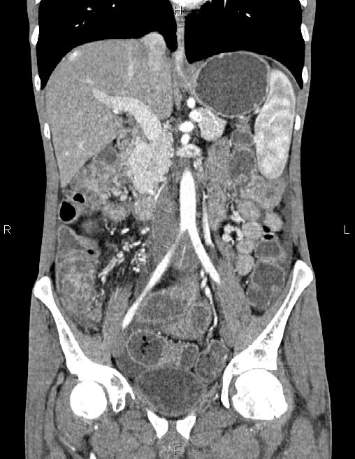 Active crohn disease (Radiopaedia 87133-103397 Coronal C+ arterial phase 31).jpg