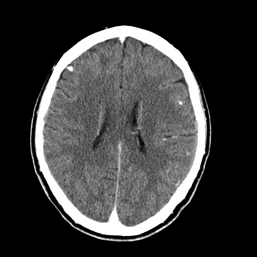 File:Active neurocysticercosis before and after therapy (Radiopaedia 71710-82099 Axial C+ delayed 38).jpg