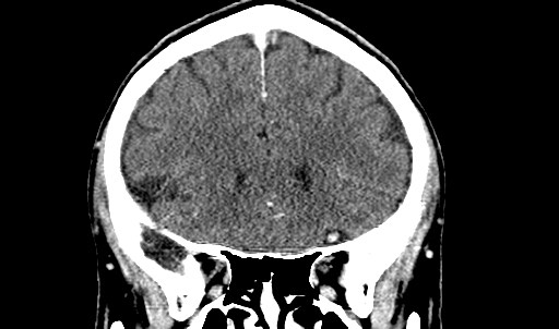 File:Active neurocysticercosis before and after therapy (Radiopaedia 71710-82099 Coronal C+ delayed 27).jpg