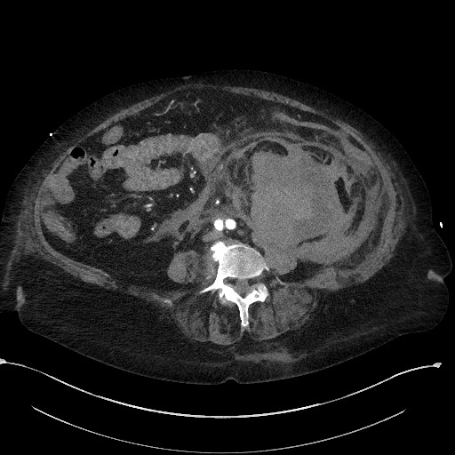 File:Active renal extravasation with large subcapsular and retroperitoneal hemorrhage (Radiopaedia 60975-68796 Axial 1).jpg