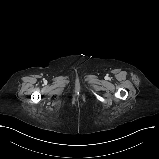File:Active renal extravasation with large subcapsular and retroperitoneal hemorrhage (Radiopaedia 60975-68796 Axial 364).jpg
