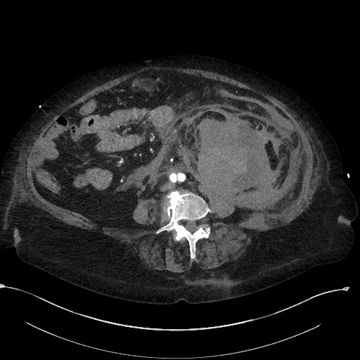 Active renal extravasation with large subcapsular and retroperitoneal hemorrhage (Radiopaedia 60975-68796 Axial C+ arterial phase 111).jpg