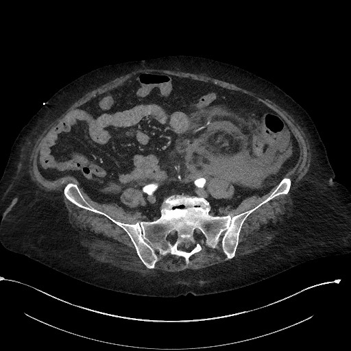 Active renal extravasation with large subcapsular and retroperitoneal hemorrhage (Radiopaedia 60975-68796 Axial C+ arterial phase 134).jpg