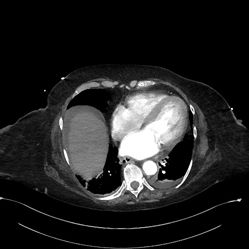 Active renal extravasation with large subcapsular and retroperitoneal hemorrhage (Radiopaedia 60975-68796 Axial C+ arterial phase 16).jpg