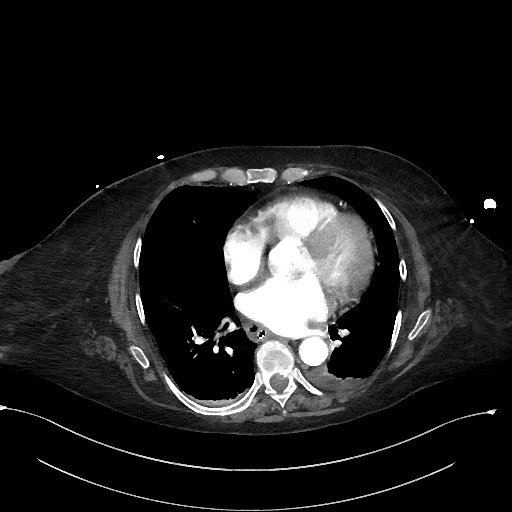 Active renal extravasation with large subcapsular and retroperitoneal hemorrhage (Radiopaedia 60975-68796 Axial C+ arterial phase 4).jpg