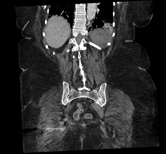 File:Active renal extravasation with large subcapsular and retroperitoneal hemorrhage (Radiopaedia 60975-68796 Coronal C+ portal venous phase 121).jpg