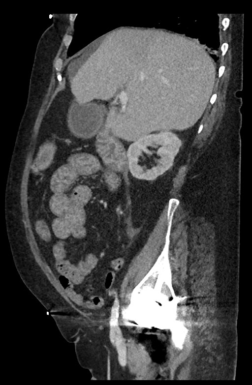 Active renal extravasation with large subcapsular and retroperitoneal hemorrhage (Radiopaedia 60975-68796 Sagittal C+ portal venous phase 155).jpg
