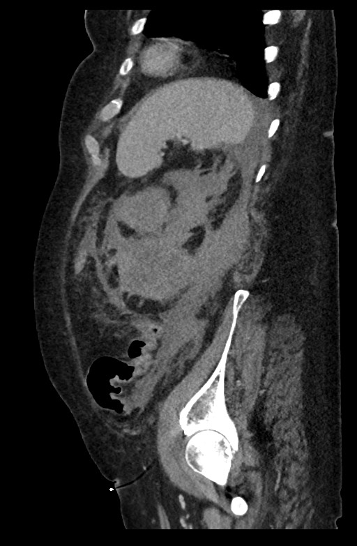 Active renal extravasation with large subcapsular and retroperitoneal hemorrhage (Radiopaedia 60975-68796 Sagittal C+ portal venous phase 66).jpg