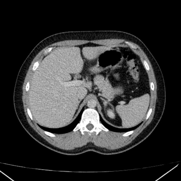 Acute appendicitis (Radiopaedia 38255-40270 Axial C+ portal venous phase 23).jpg
