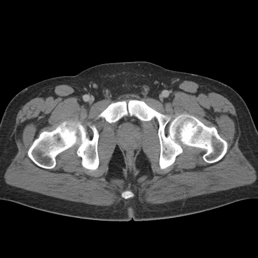 Acute appendicitis (Radiopaedia 48511-53463 Axial C+ portal venous phase 102).jpg