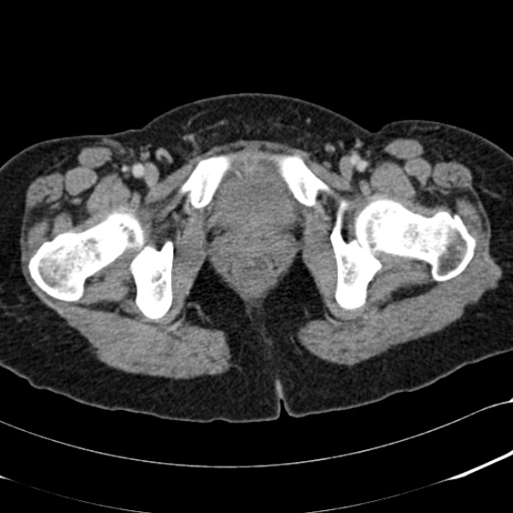 Acute appendicitis (Radiopaedia 48792-53822 Axial C+ portal venous phase 119).jpg