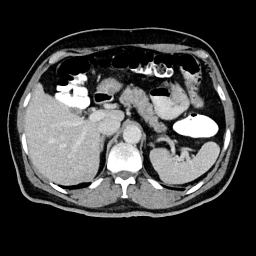 Acute appendicitis (Radiopaedia 77016-88960 Axial C+ portal venous phase 39).jpg