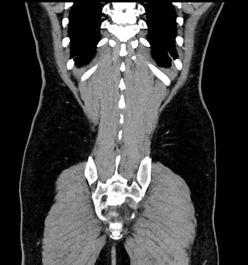 Acute appendicitis (Radiopaedia 77016-88960 Coronal C+ portal venous phase 84).jpg
