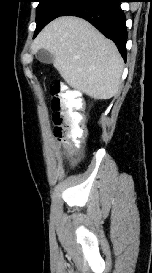 Acute appendicitis (Radiopaedia 77016-88960 Sagittal C+ portal venous phase 94).jpg