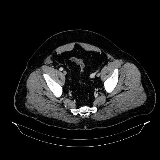 Acute appendicitis (Radiopaedia 79950-93224 Axial C+ portal venous phase 88).jpg