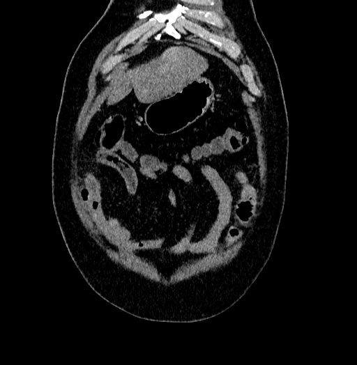 Acute appendicitis (Radiopaedia 79950-93224 Coronal C+ portal venous phase 10).jpg