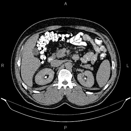 Acute appendicitis (Radiopaedia 84780-100240 Axial C+ delayed 36).jpg