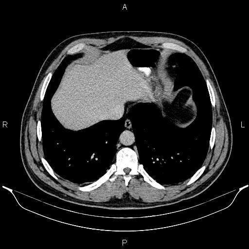 Acute appendicitis (Radiopaedia 84780-100240 Axial C+ portal venous phase 12).jpg