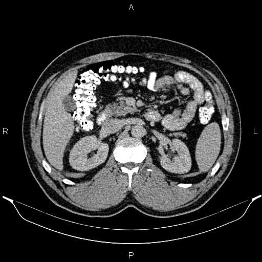 Acute appendicitis (Radiopaedia 84780-100240 Axial C+ portal venous phase 39).jpg
