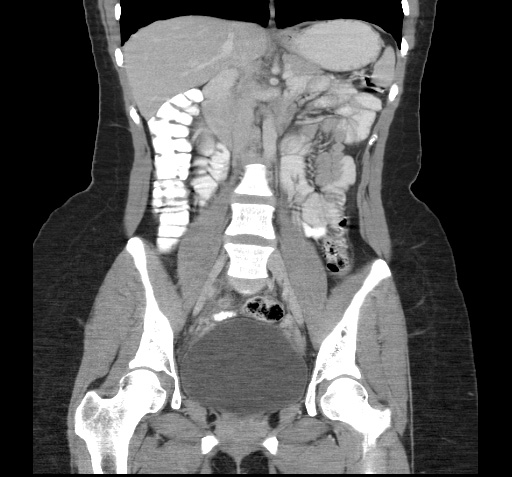 File:Acute appendicitis (Radiopaedia 9417-10099 Coronal C+ portal venous phase 5).jpg