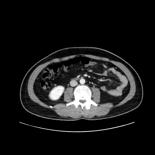 Acute appendicitis and COVID 19 pneumonia (Radiopaedia 76604-88380 Axial C+ portal venous phase 42).jpg