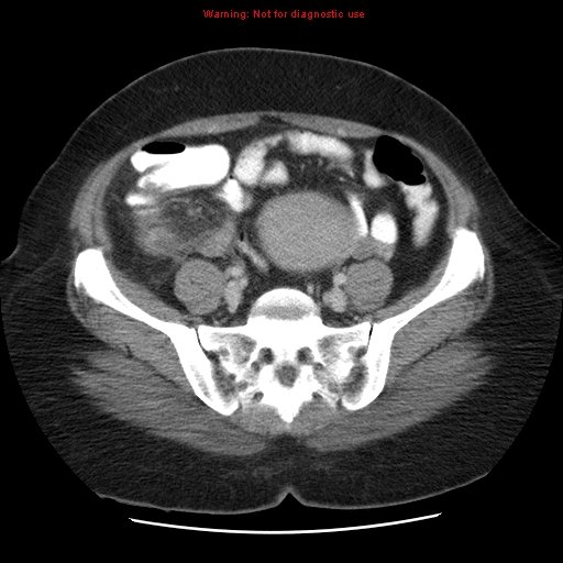 Acute appendicitis complicated by ovarian vein thrombophlebitis (Radiopaedia 16172-15851 Axial C+ portal venous phase 68).jpg