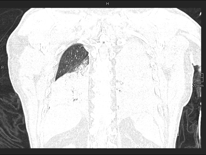 File:Acute aspiration pneumonitis (Radiopaedia 55642-62166 Coronal lung window 85).jpg