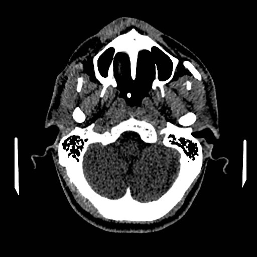 File:Acute basilar artery occlusion (Radiopaedia 43582-46985 Axial non-contrast 39).jpg