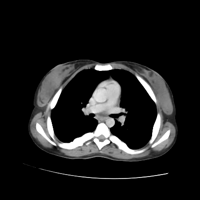Acute calculous cholecystitis in patient with osteopetrosis (Radiopaedia 77871-90159 Axial C+ portal venous phase 2).jpg