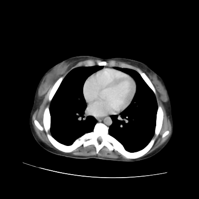 Acute calculous cholecystitis in patient with osteopetrosis (Radiopaedia 77871-90159 Axial C+ portal venous phase 8).jpg