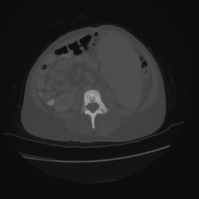 File:Acute calculous cholecystitis in patient with osteopetrosis (Radiopaedia 77871-90159 Axial bone window 30).jpg
