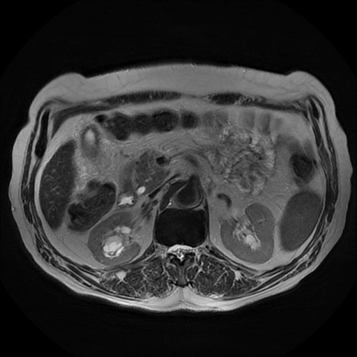 File:Acute cholecystitis complicated by pylephlebitis (Radiopaedia 65782-74915 Axial T2 22).jpg