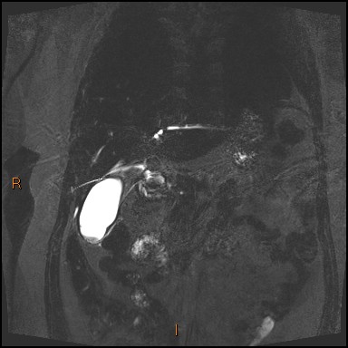 File:Acute cholecystitis with gallbladder neck calculus (Radiopaedia 42795-45971 Coronal Turbo spin echo 33).jpg