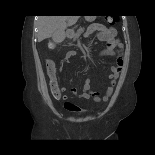 File:Acute cholecystitis with tensile fundus sign (Radiopaedia 71394-81723 Coronal non-contrast 52).jpg