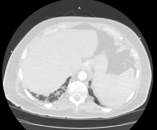 Acute cor pulmonale (ultrasound) (Radiopaedia 83508-98818 Axial lung window 81).jpg