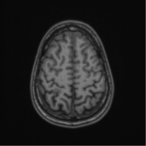 Acute disseminated encephalomyelitis (ADEM) (Radiopaedia 65319-74349 Axial T1 56).png