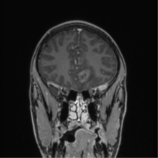 Acute disseminated encephalomyelitis (ADEM) (Radiopaedia 65319-74349 Coronal T1 C+ 44).png