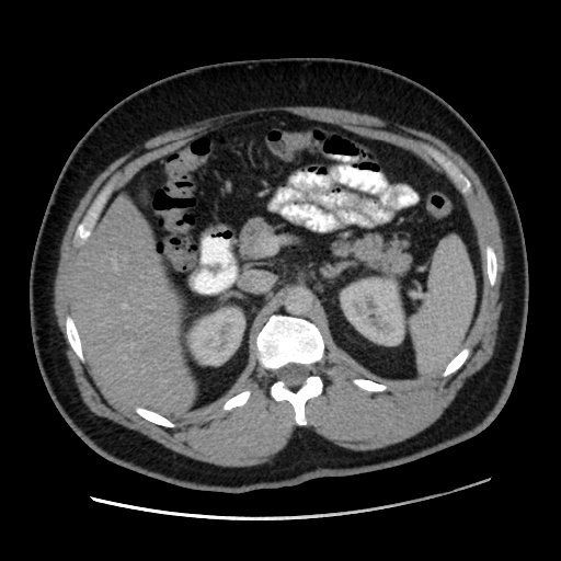 File:Acute diverticulitis with localized perforation (Radiopaedia 41296-44113 Axial C+ portal venous phase 30).jpg