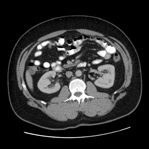 File:Acute diverticulitis with localized perforation (Radiopaedia 41296-44113 Axial C+ portal venous phase 40).jpg