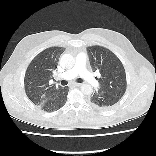 Acute epicardial fat necrosis (Radiopaedia 42327-45440 Axial lung window 27).jpg