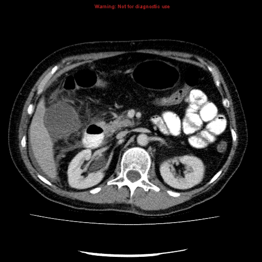 Acute gangrenous cholecystitis (Radiopaedia 10123-10661 Axial C+ portal venous phase 37).jpg