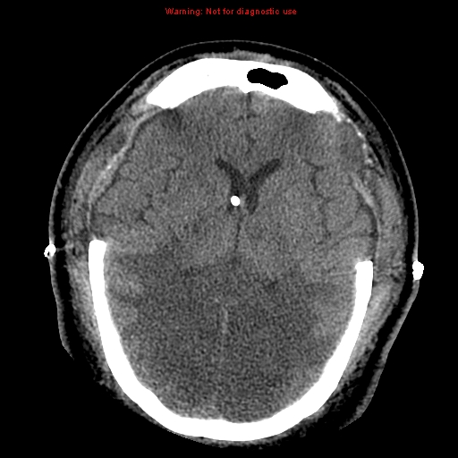 Acute hemorrhagic leukoencephalitis (Radiopaedia 14076-43697 Axial non-contrast 27).jpg