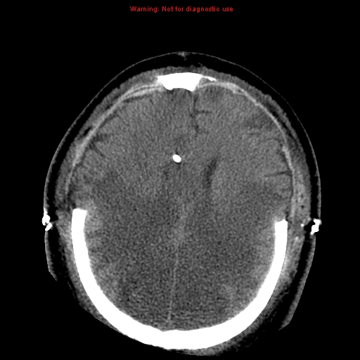 Acute hemorrhagic leukoencephalitis (Radiopaedia 14076-43697 Axial non-contrast 33).jpg