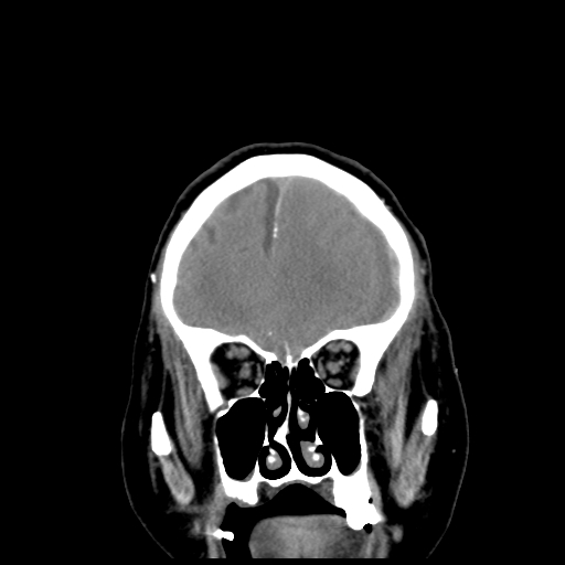 Acute hemorrhagic stroke (Radiopaedia 17507-17223 Coronal non-contrast 11).jpg